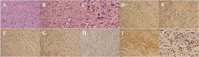 Case report: Orbital myeloid sarcoma: a report of two rare cases and review of the literature